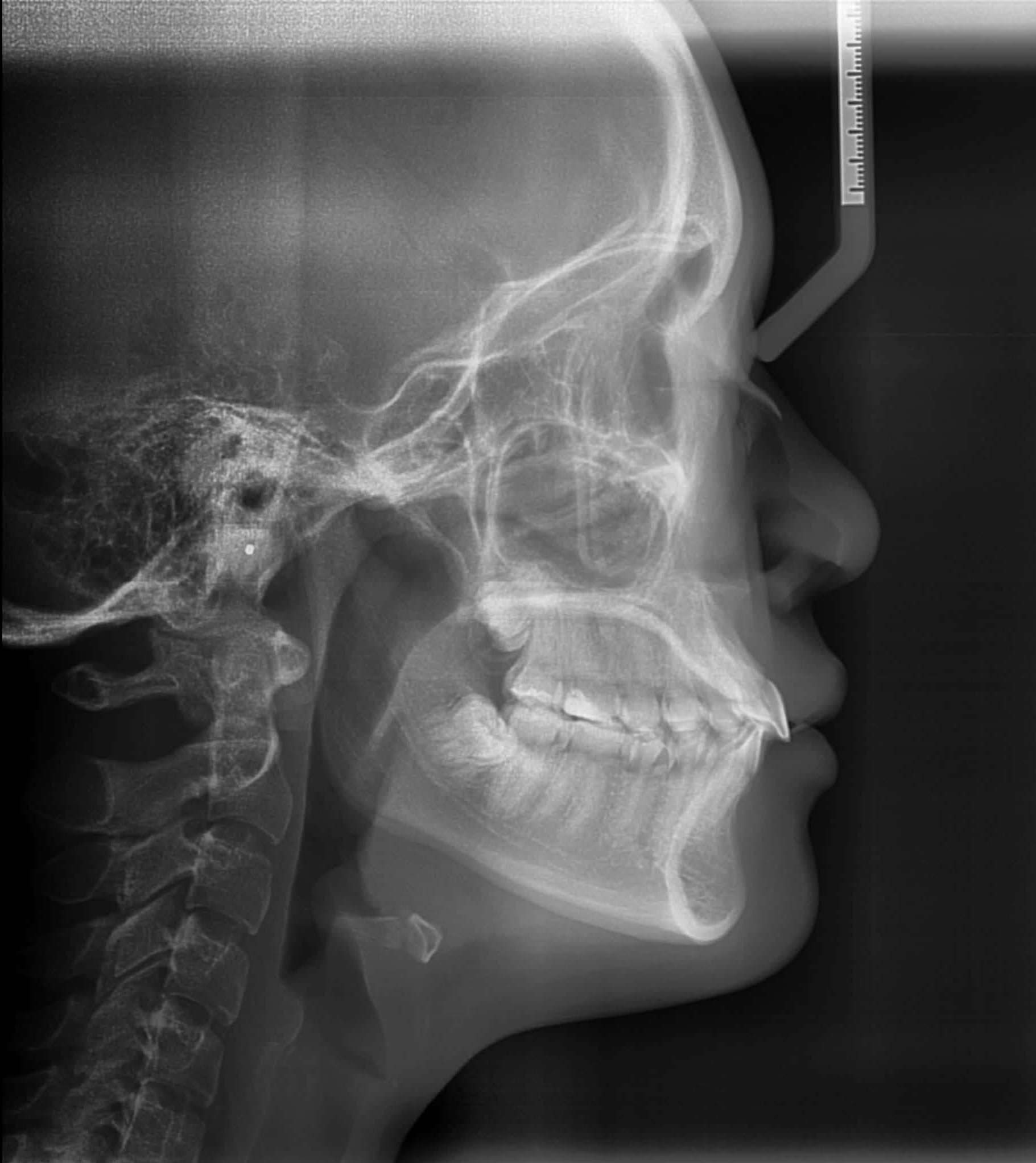 Comprehensive ALL-ON-X Rehabilitation